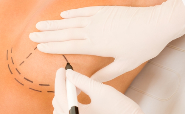 AOK fordert Haftpflichtversicherung für Brustimplantate