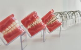 Kosten für Zahnspangen im Visier der Krankenkassen